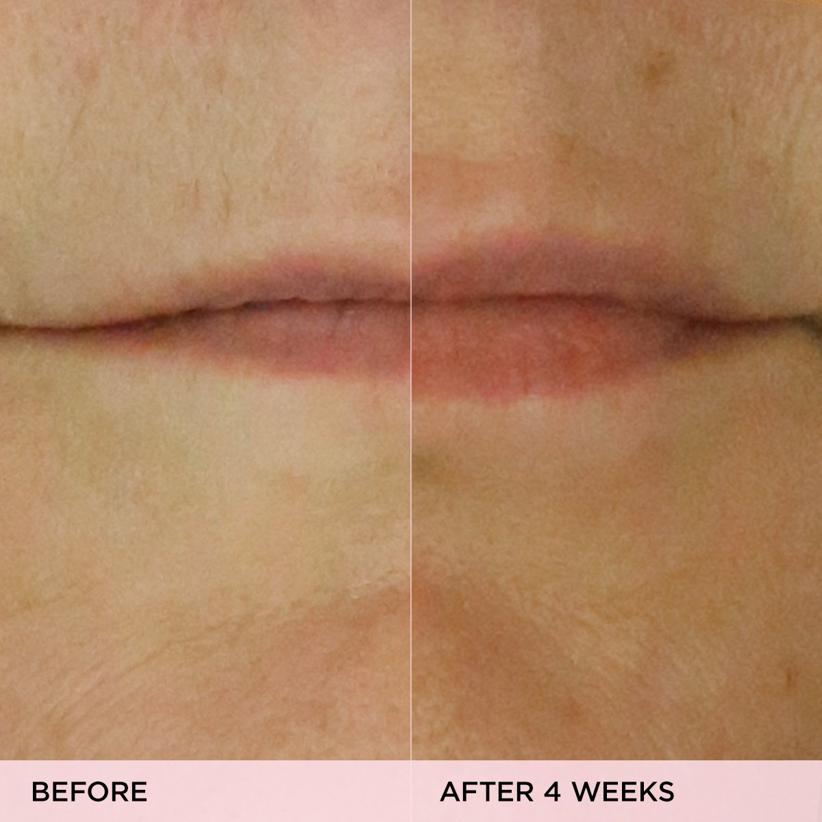 The Kissu Lip Treatment Before & After