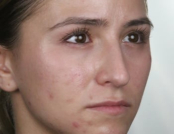 What Is an Oily Skin Type and How to Tell If You Have It